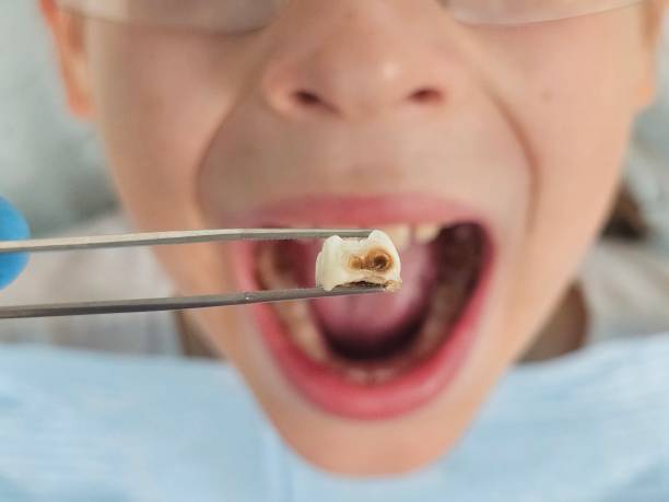Best Emergency Tooth Extraction in Lakewood, OH